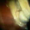 laparoscopia ovario