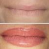 Relleno y contorno labios