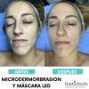 TRATAMIENTO FACIAL MICRODERMOABRASIÓN Y MÁSCARA LED