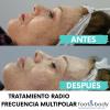 TRATAMIENTO FACIAL RADIOFRECUENCIA MULTIPOLAR