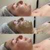 Limpieza facial