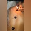 Moxibustion 