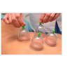 Terapia con ventosas (cupping)