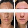 Manchas Melasma