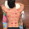 ventosas ( cupping) ideal para deportistas