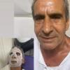 Eliminación de Verrugas/ Facial rejuvenecedor