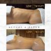 Linfosculpt  Masajes A Domicilio